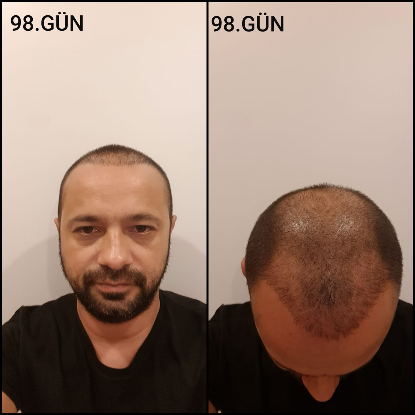 Заживление после пересадки волос день 98 – средняя фаза заживления с шоковым выпадением и дальнейшим процессом заживления