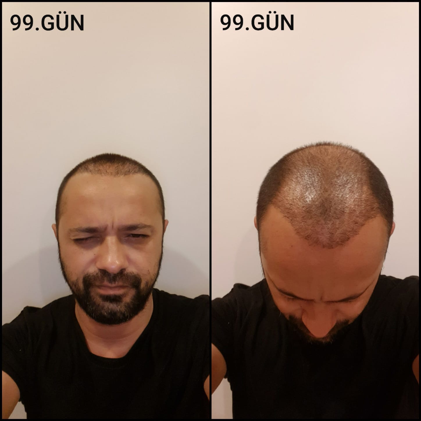 Заживление после пересадки волос день 99 – средняя фаза заживления с шоковым выпадением и дальнейшим процессом заживления