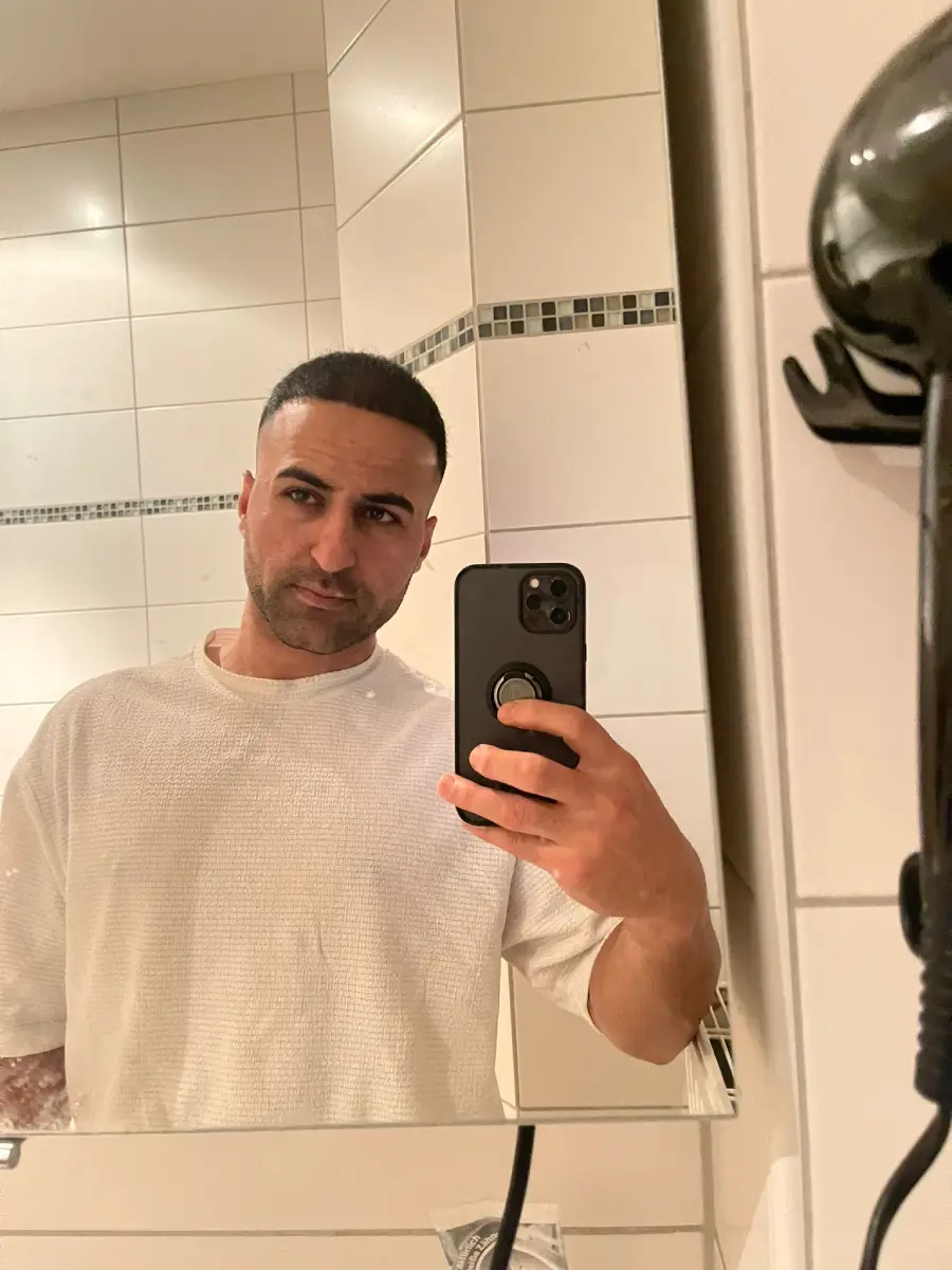 after buzz cut transplant