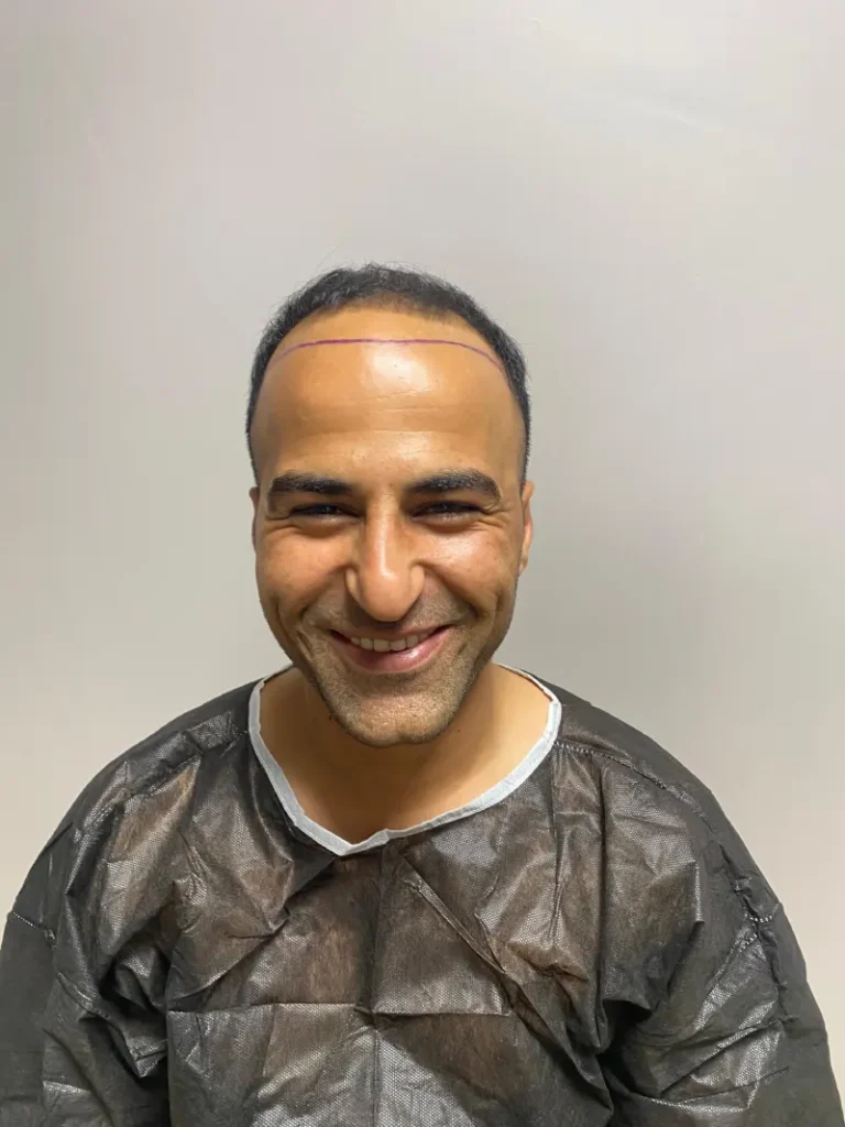 vor der Buzz-Cut-Haartransplantation