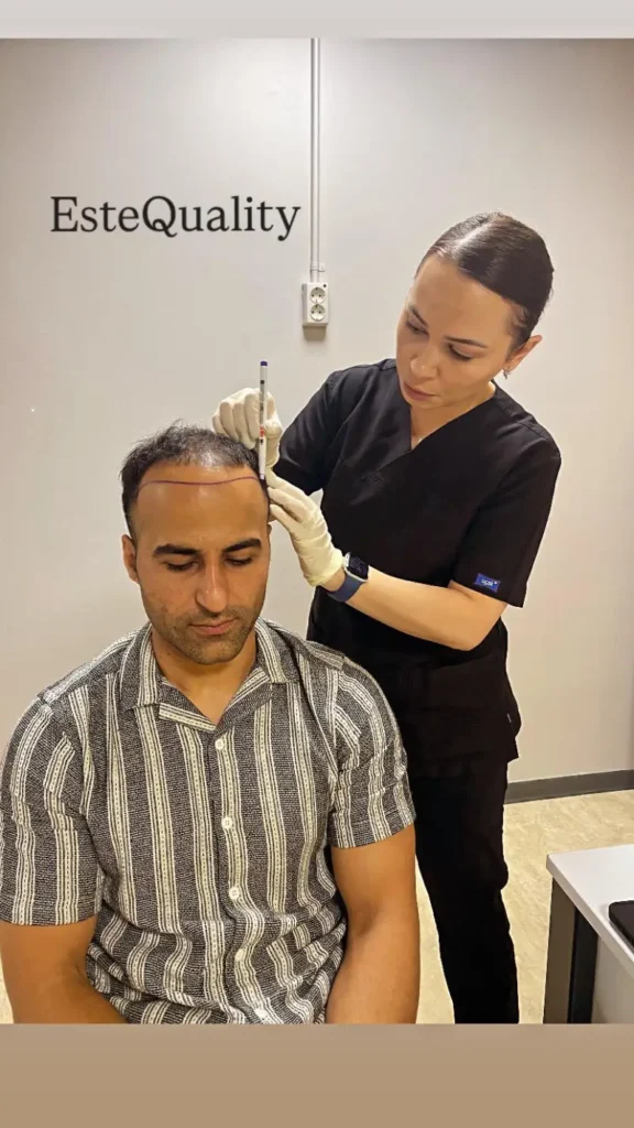 Buzz-Cut-Transplantationsverfahren
