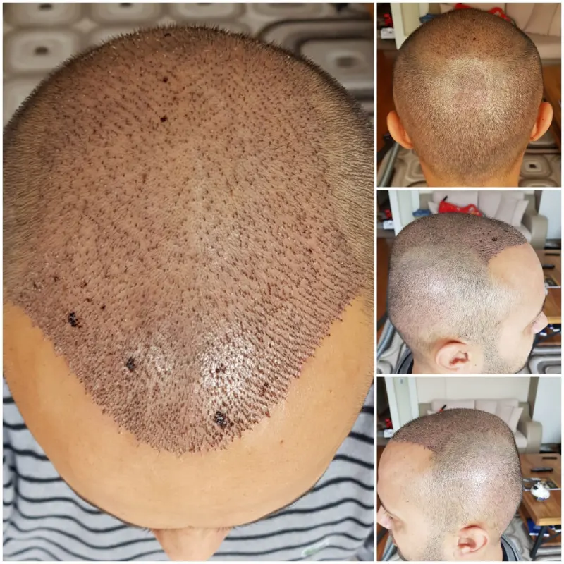 hair transplant real photos