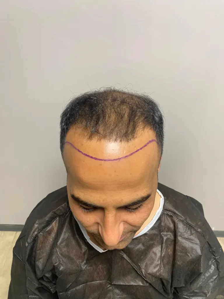 Buzz-Cut-Haartransplantation mit natürlicher Haarlinie