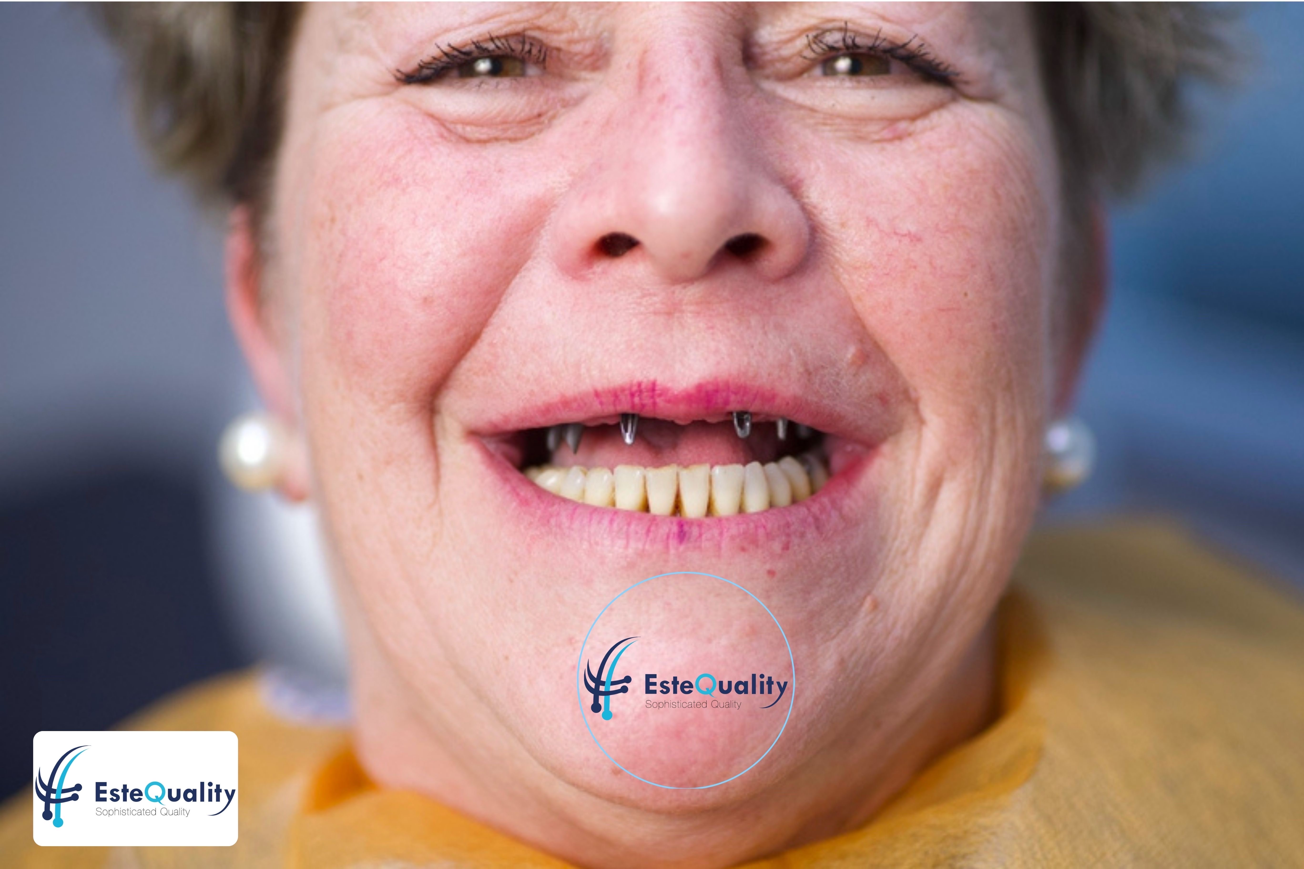 Patient vor der endgültigen Zahnimplantat-Restauration in der Türkei bei EsteQuality