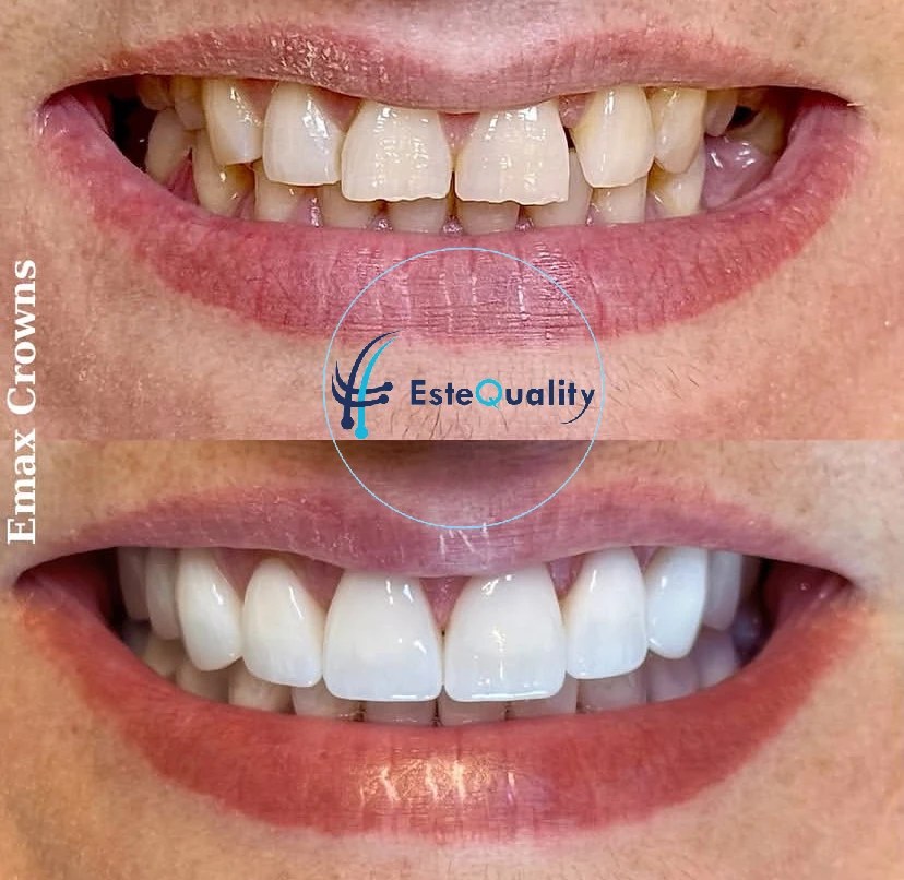 Nahaufnahme des Vorher-Nachher-Ergebnisses von Emax-Kronen in der Türkei bei EsteQuality