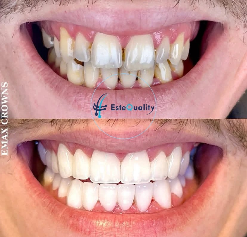 Vorher-Nachher-Ergebnis von Emax-Kronen bei einem männlichen Patienten in der Türkei bei EsteQuality