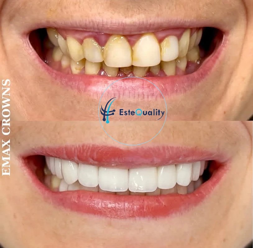 Vorher-Nachher-Lächelverwandlung mit Emax-Kronen in der Türkei bei EsteQuality