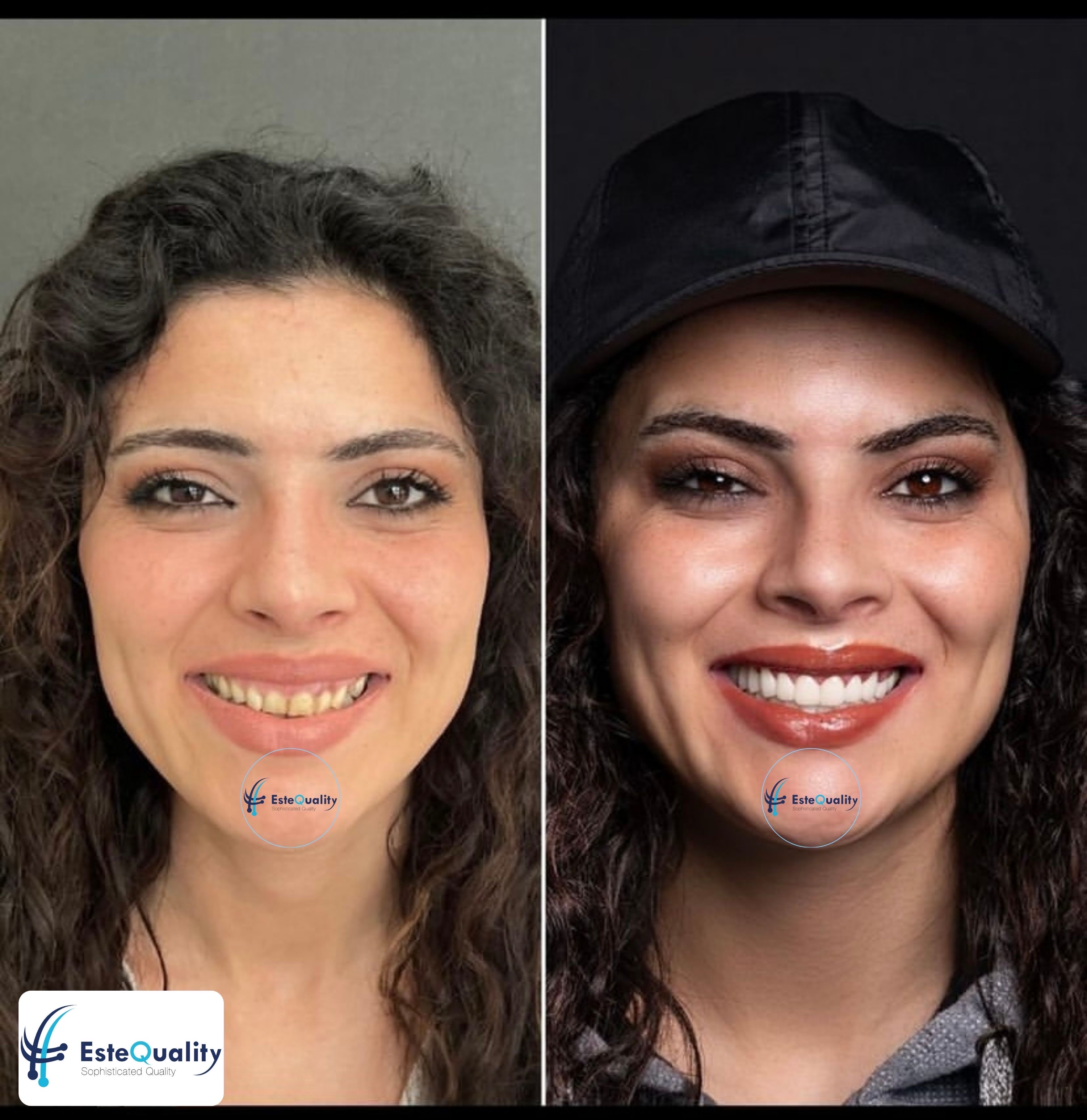 Vorher-Nachher-Verwandlung eines weiblichen Smile-Makeovers in der Türkei bei EsteQuality