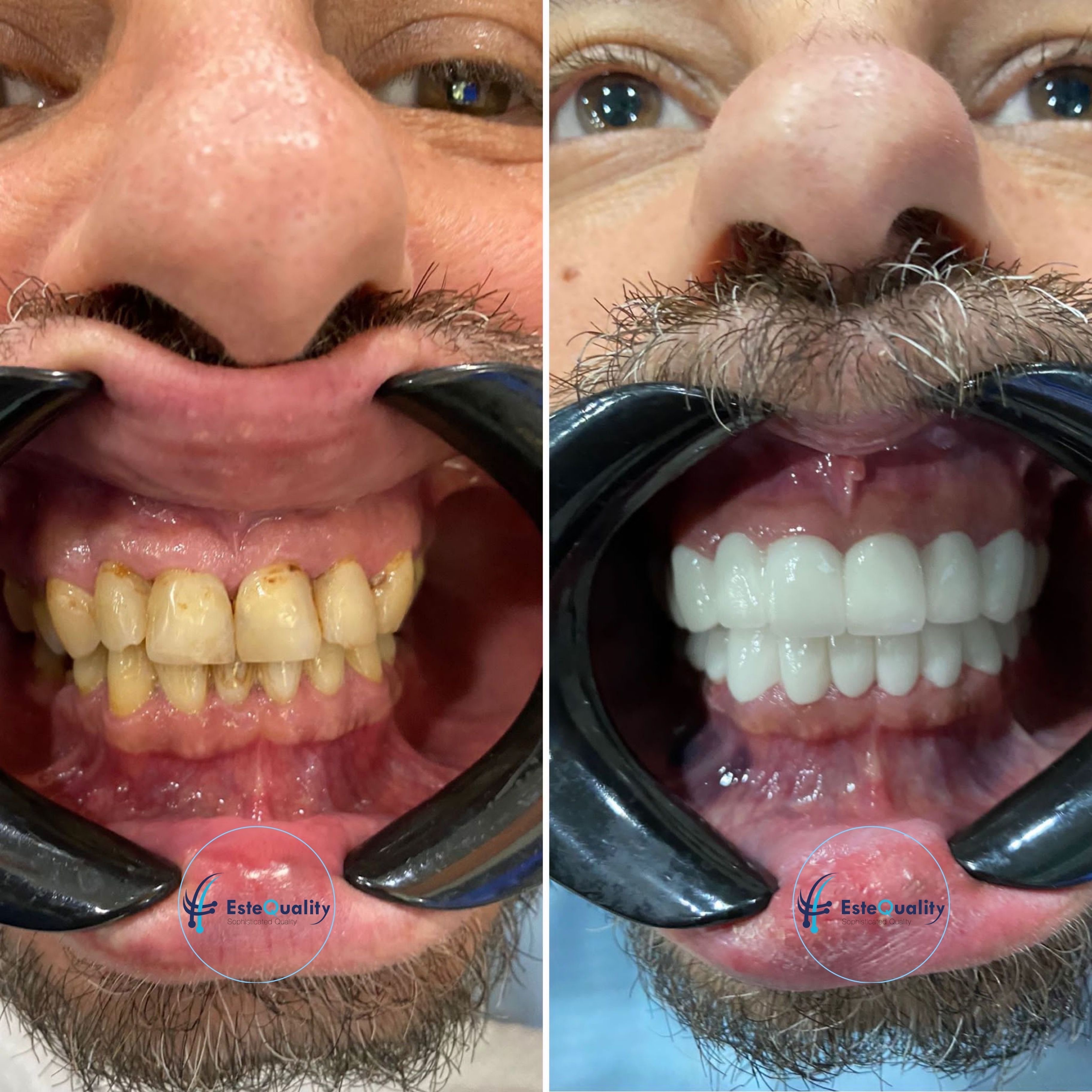 Vorher-Nachher-Ergebnis von Zahnkronen im gesamten Mundbereich in der Türkei bei EsteQuality