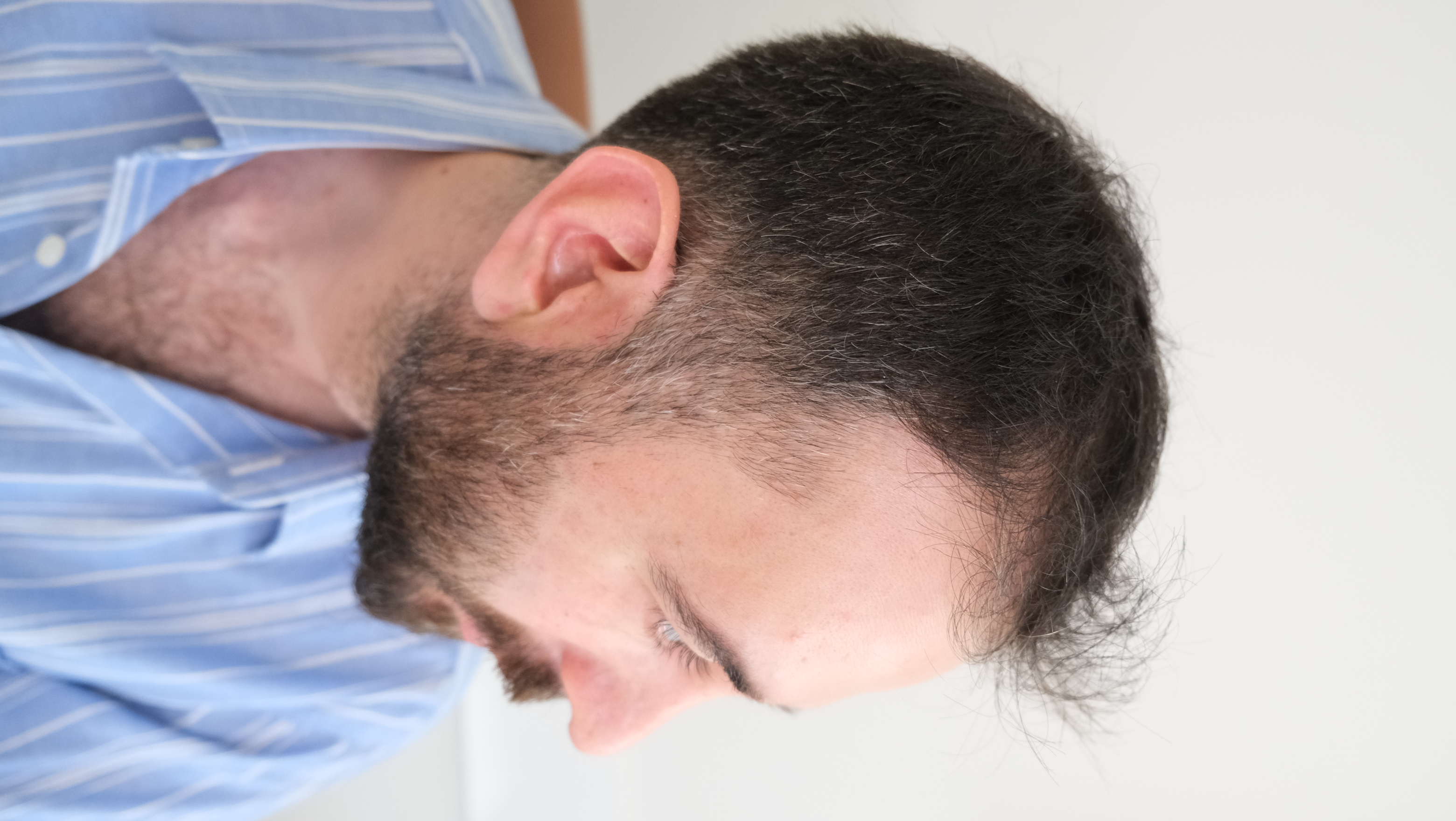Assessment of the frontal hairline from the side profile before the hair transplant