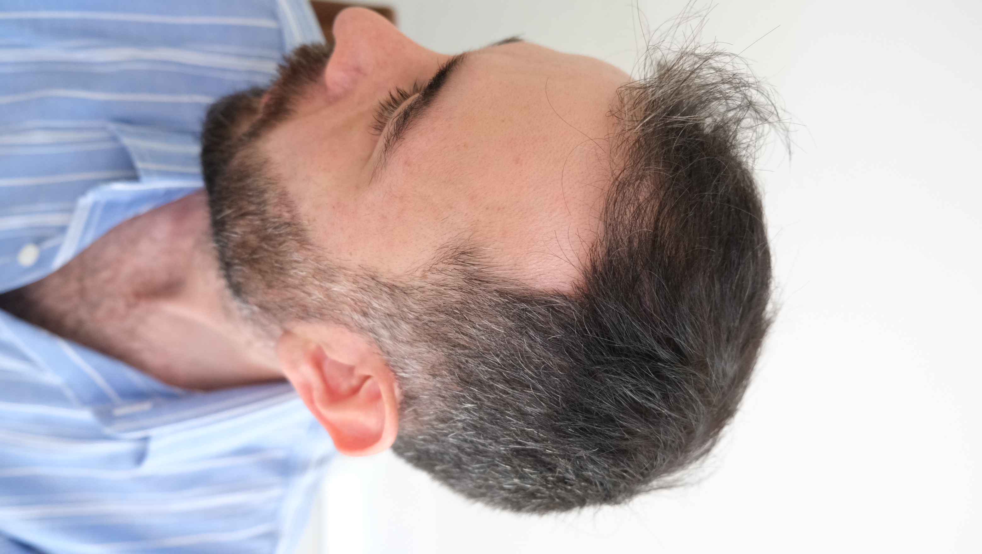 Assessment of the frontal hairline and temple area from another angle
