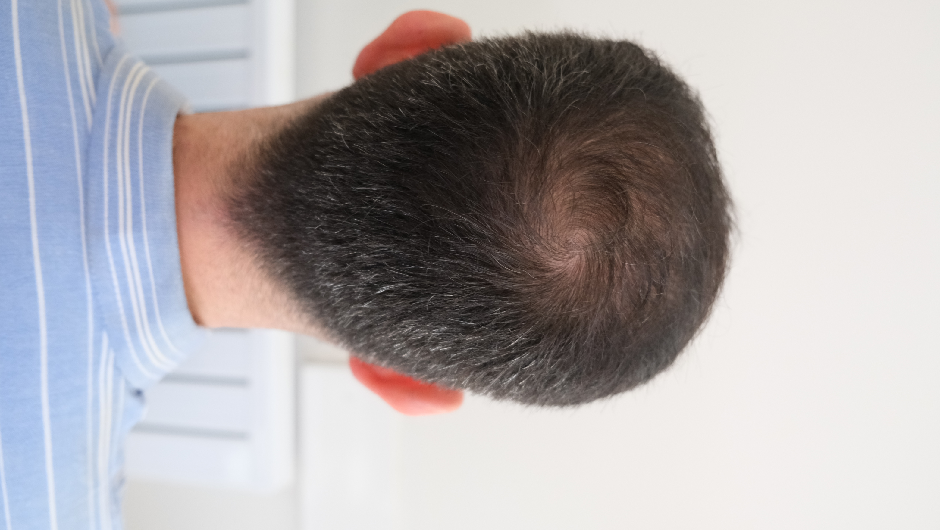 Assessment of the back of the scalp and donor area before the hair transplant