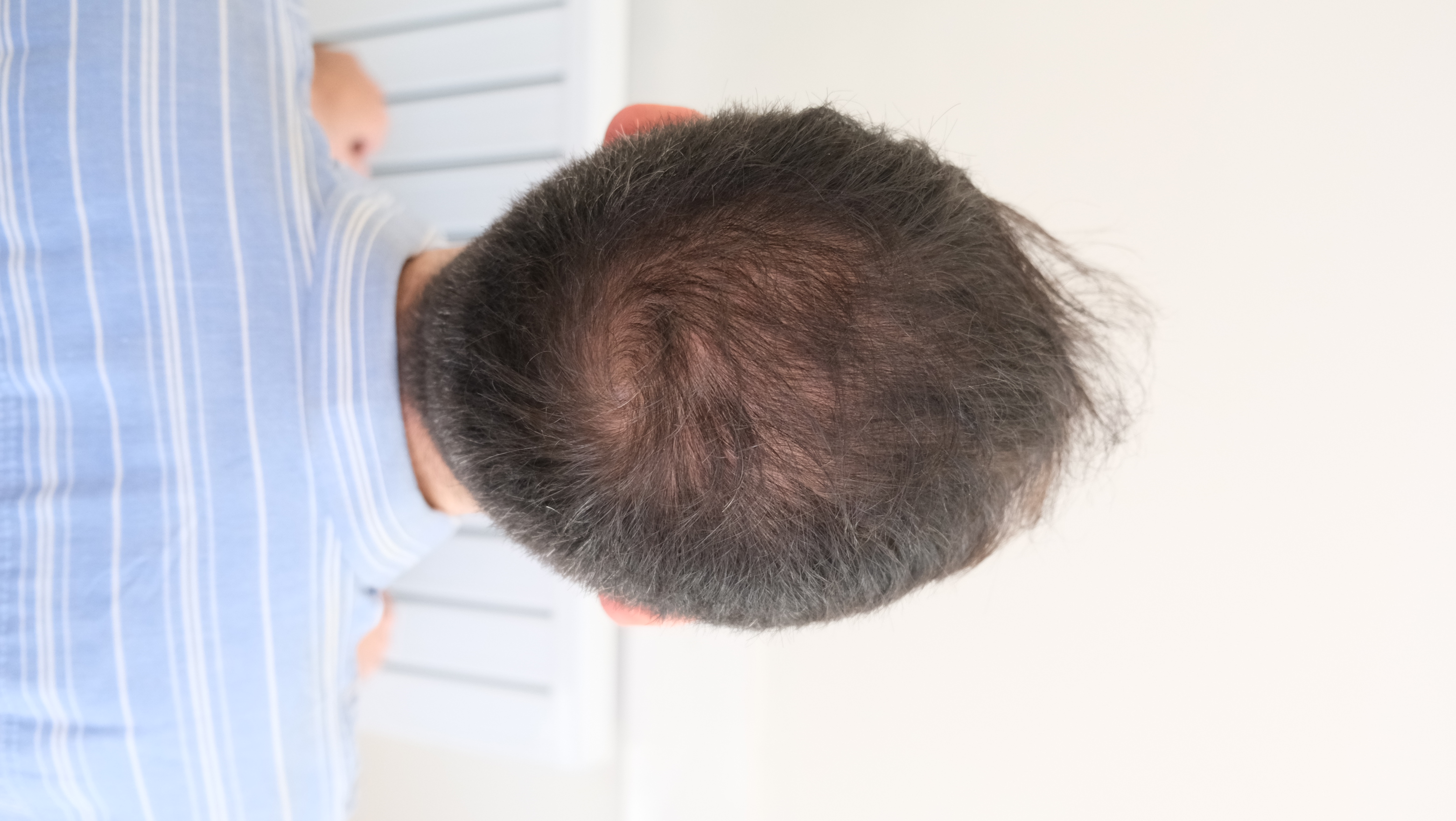 Assessment of the crown area from above before the hair transplant