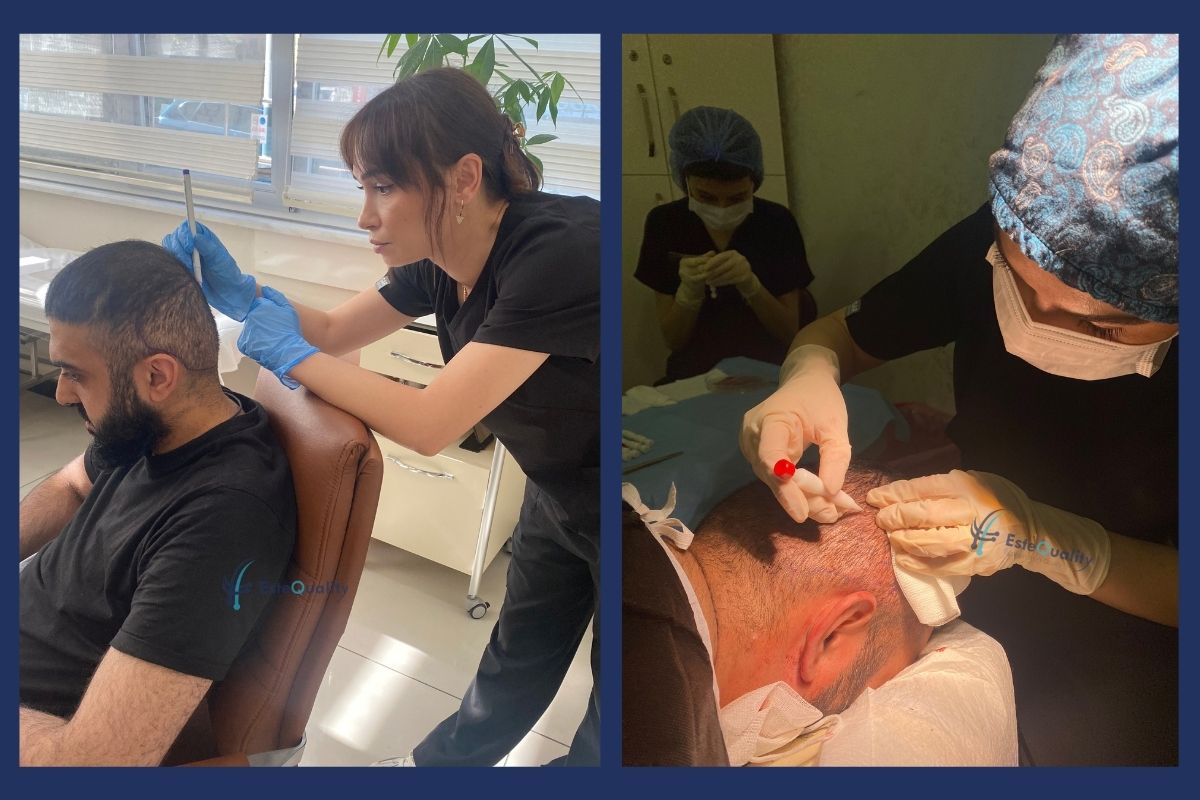 EsteQuality clinicians assessing and mapping a patient donor area before a hair transplant