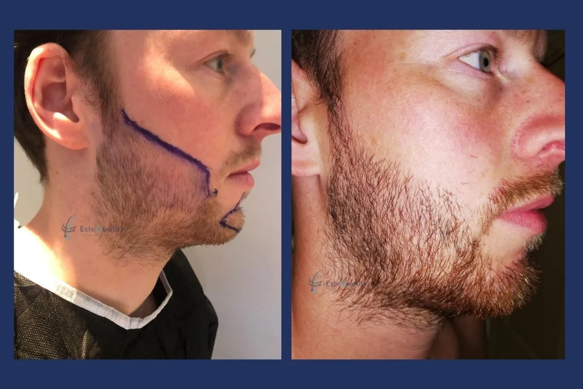 3.000 Grafts, DHI, Wange und Kieferlinie. Das Vorher-Foto zeigt die geplante Bartlinie. Ergebnis nach 8 Monaten.