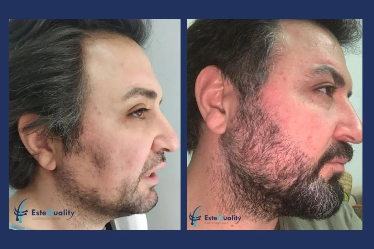 3.600 Grafts, Sapphire FUE, vollständige Abdeckung von Wangen und Kieferlinie bei einem von Natur aus lichten Bart. Ergebnis nach 10 Monaten.