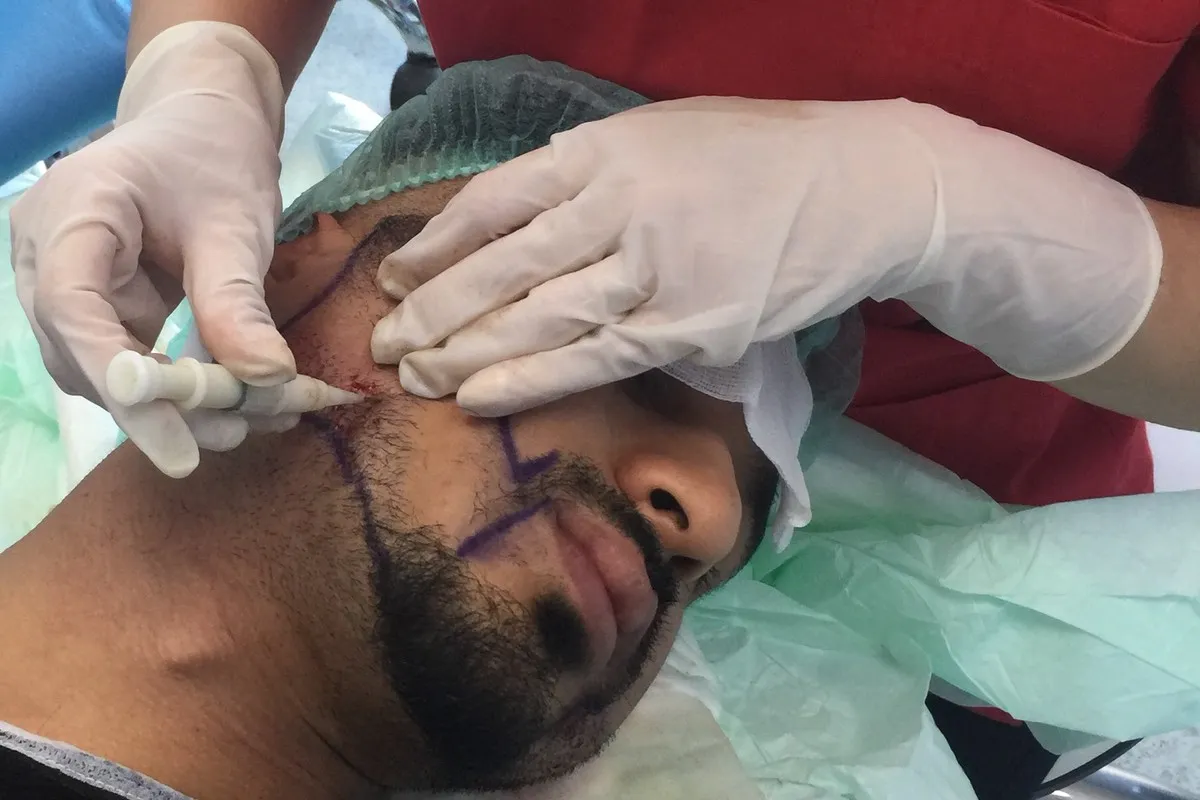 Beard transplant in progress: DHI implanter placing a graft along the marked beard line on the cheek