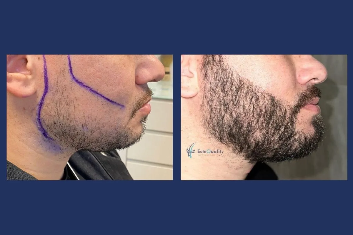 Beard transplant before and 9 months after 4,000 grafts with Sapphire FUE, left profile
