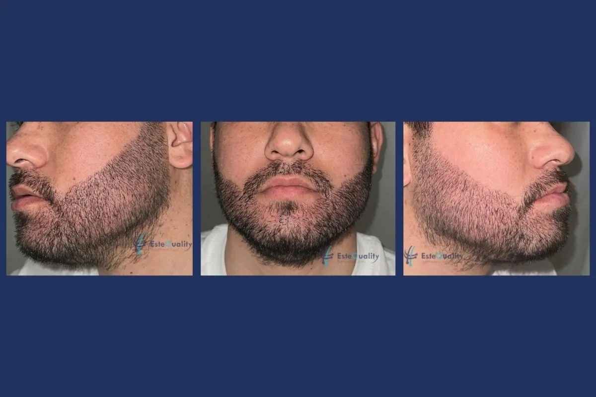 Beard transplant 10 days after the procedure: crusts shed, mild redness remaining, three views