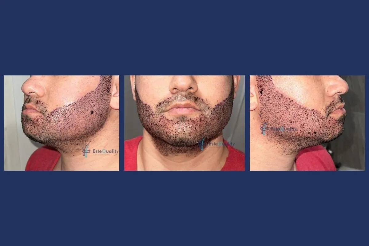 Beard transplant 2 days after the procedure: small crusts and redness across the treated area, three views