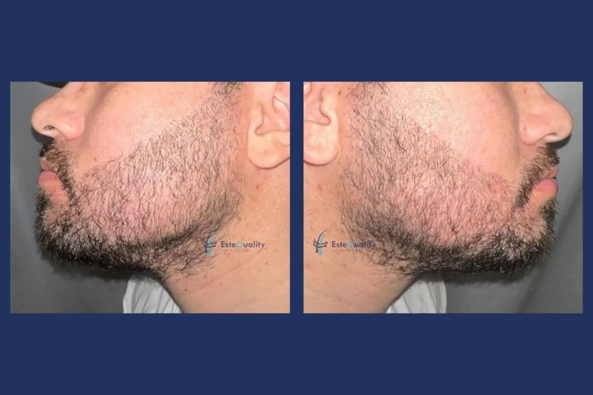 Beard transplant 30 days after the procedure, after shock shedding: transplanted hairs have shed, existing beard unchanged