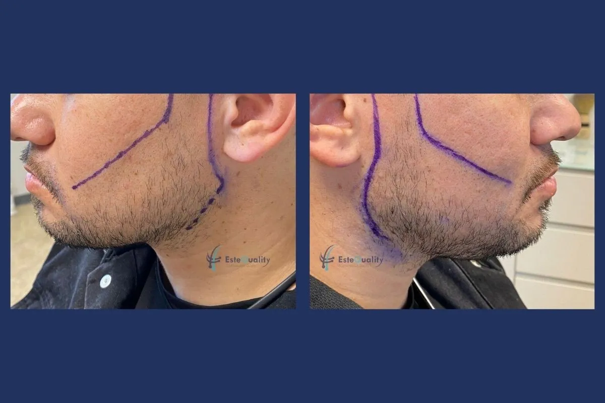 Beard transplant design: the planned beard line drawn on both cheeks before the procedure