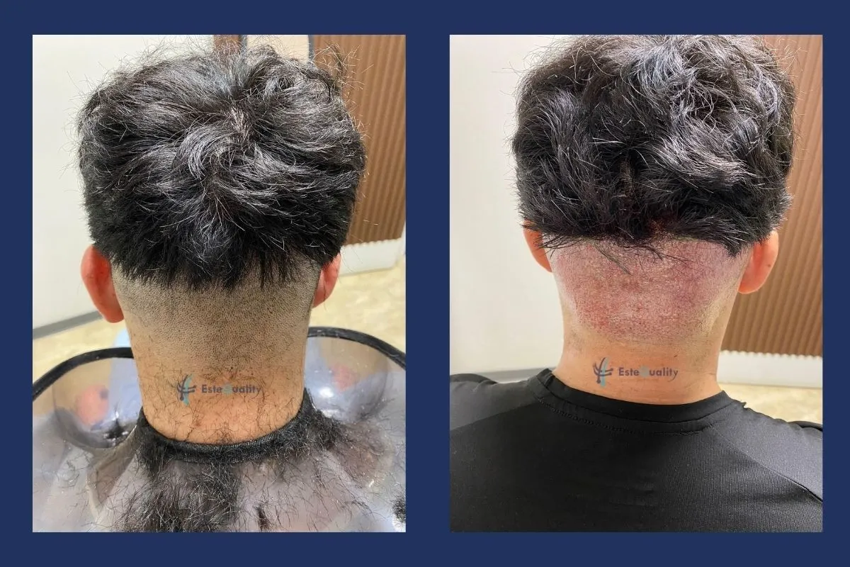 Donor area at the back of the scalp before a 4,000-graft beard transplant and the day after extraction
