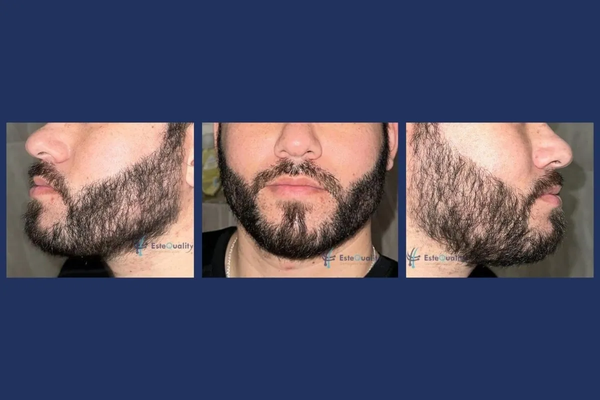 Beard transplant result at 9 months after 4,000 grafts with Sapphire FUE, left profile, front and right profile