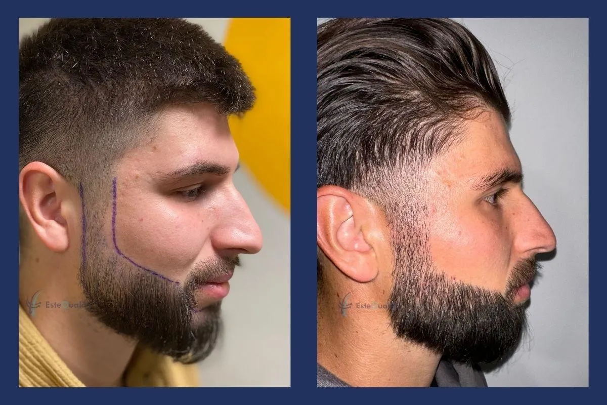 Beard repair, left side, before and 9 months after 4,000 grafts with Sapphire FUE