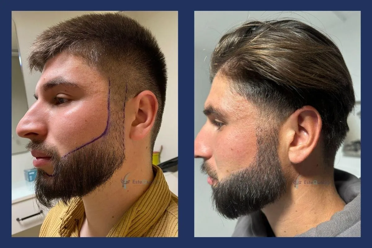 Beard repair, right side, before and 9 months after 4,000 grafts with Sapphire FUE