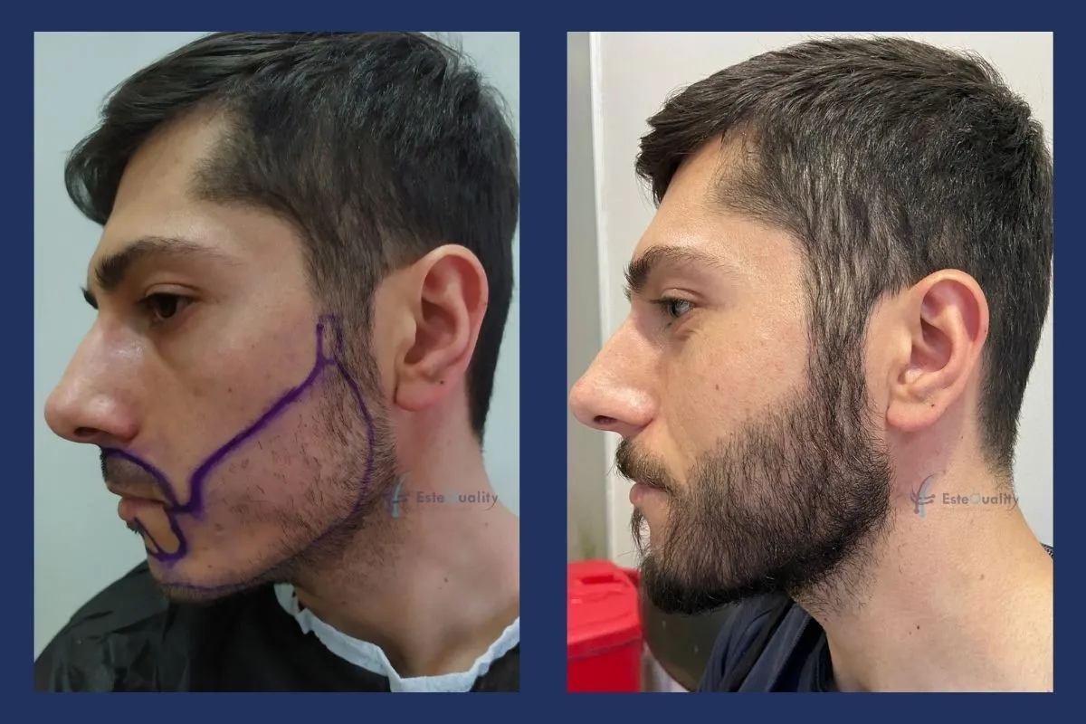 4.750 Grafts, Sapphire FUE, vollständiges Bartdesign. Ergebnis nach 9 Monaten.