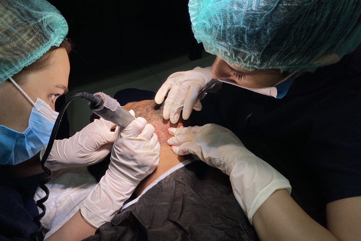 Beard graft extraction in FUE