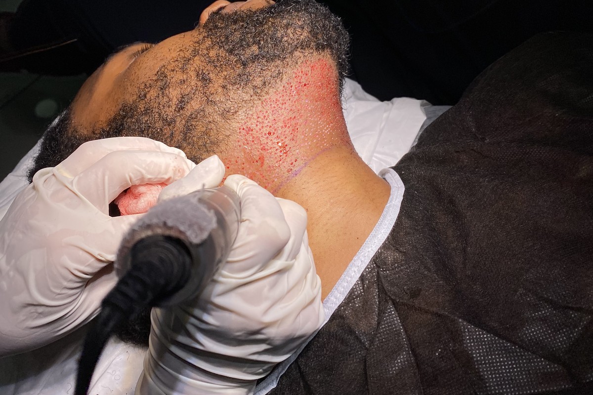 Graft extraction from the beard donor area under the jaw with a FUE micromotor