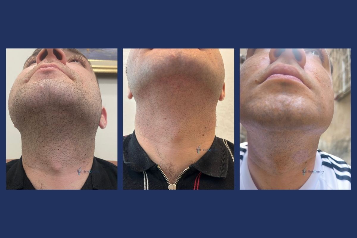 Beard donor area under the chin before, 10 days after, and 4 months after 2,500 grafts were taken with DHI