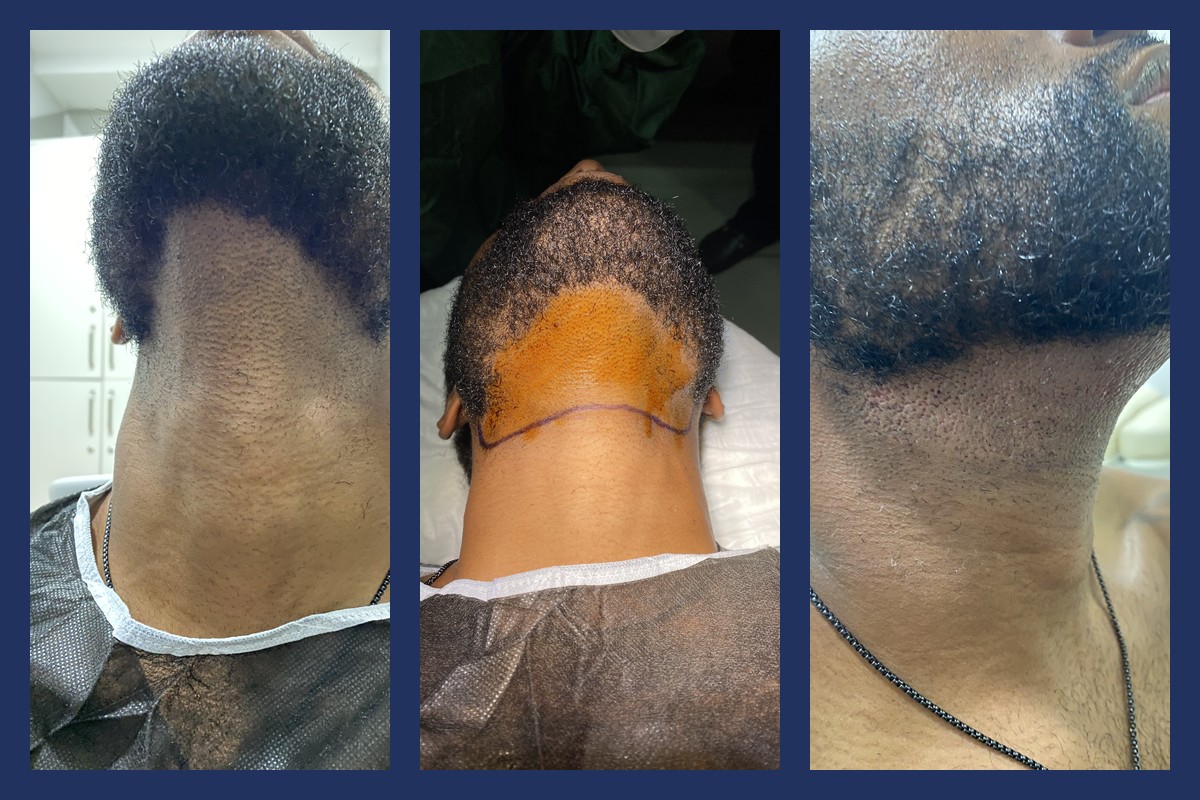 Beard donor area under the chin: before, prepared for extraction, and the day after 900 grafts were taken