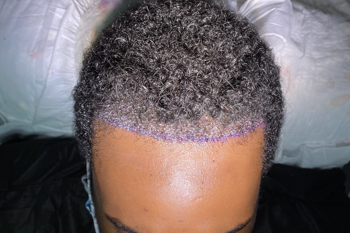 Hairline planning marked before an unshaven DHI hair transplant using beard grafts