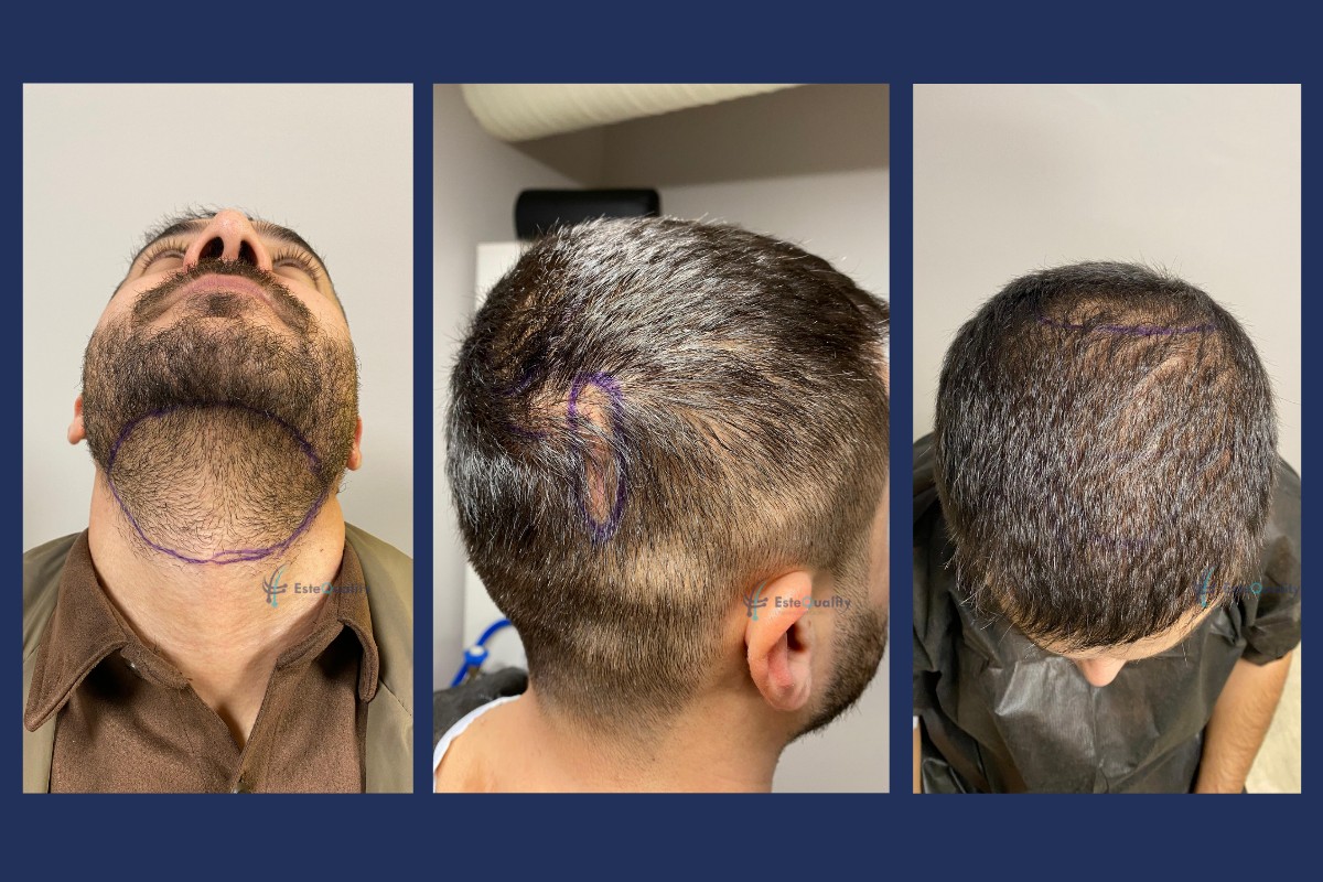 Beard donor area marked under the chin and recipient zones marked on the scalp before an unshaven DHI hair transplant