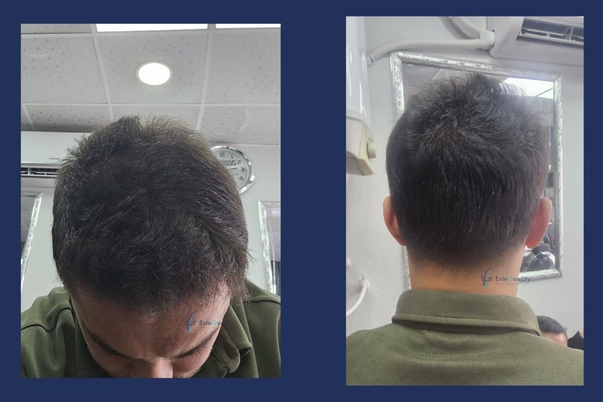 Scalp at 9 months after 1,700 beard grafts implanted with unshaven DHI, top and back views