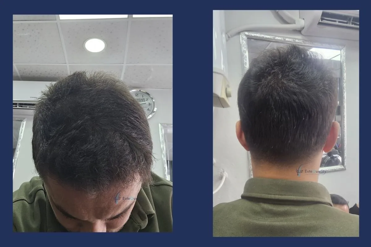 1.700 Grafts, alle unter dem Kinn entnommen und mit unrasierter DHI implantiert. Der während der Planung eingekreiste lichte Bereich hat