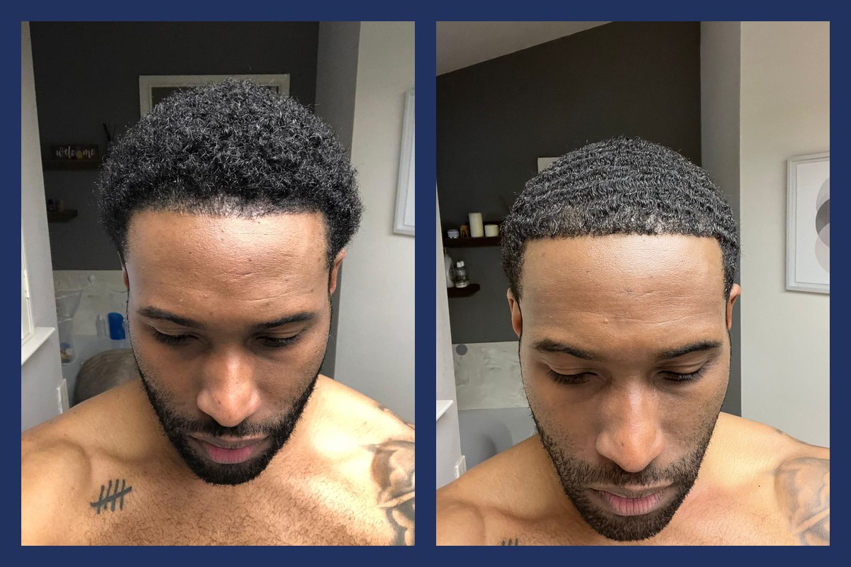Frontal hairline before and 8 months after 900 beard grafts implanted with unshaven DHI, correcting an uneven line from a previous transplant