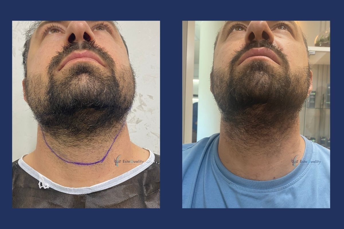 Beard donor area under the chin before and 5 months after 1,300 grafts were taken with Sapphire FUE