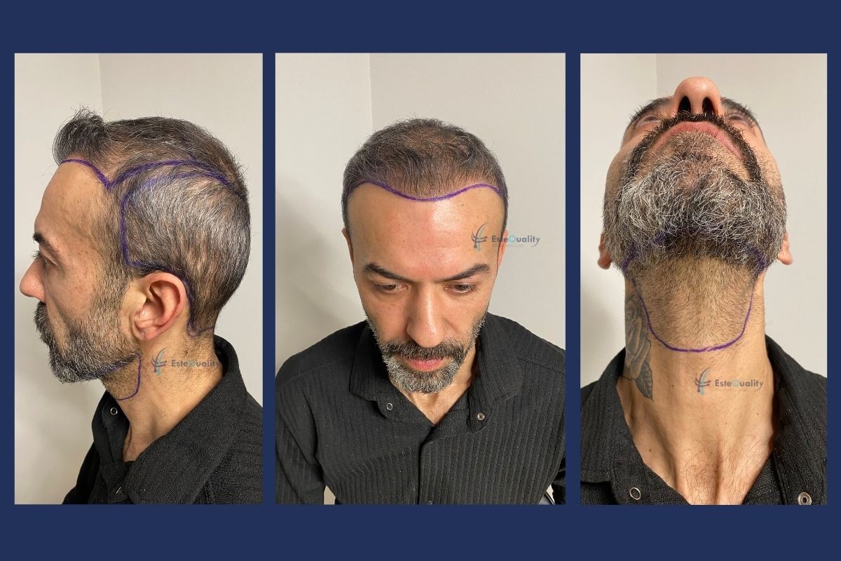 Hairline and beard donor area marked before a second-session hair transplant using scalp and beard grafts