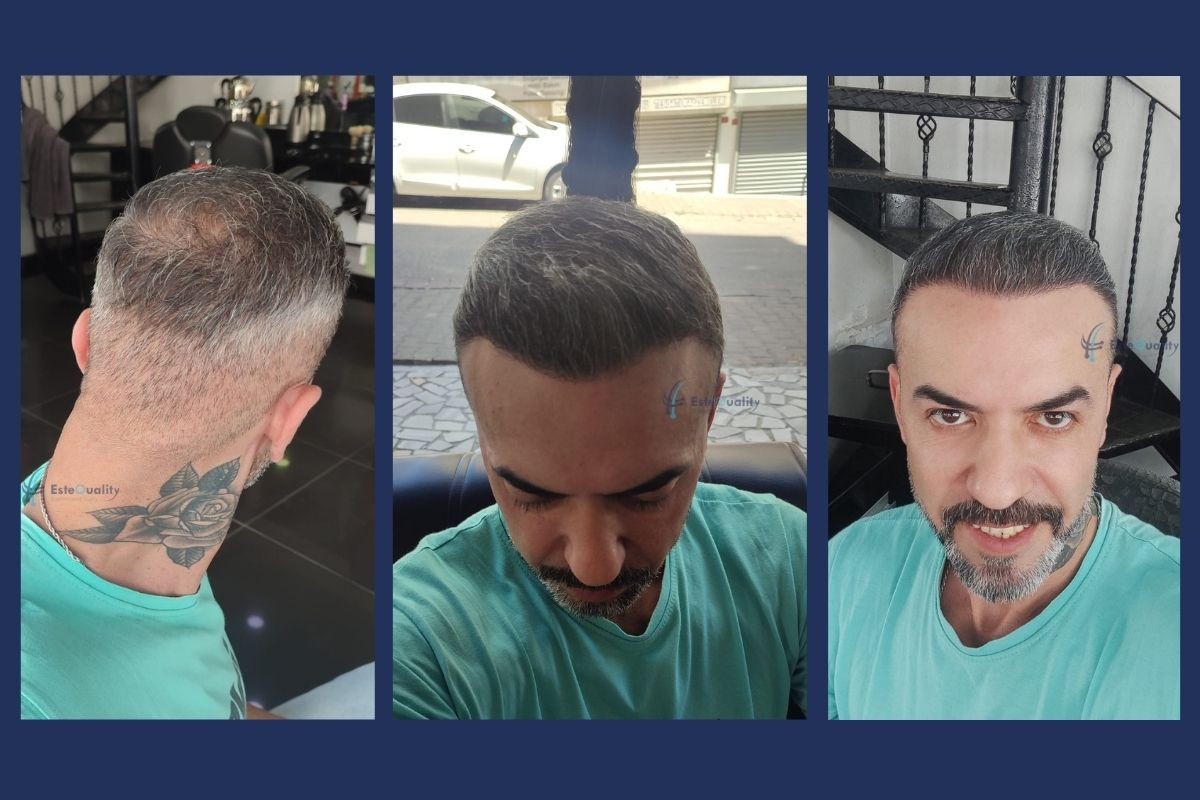 Back, top and front views 6 months after a 6,000-graft second-session hair transplant using 1,700 beard grafts