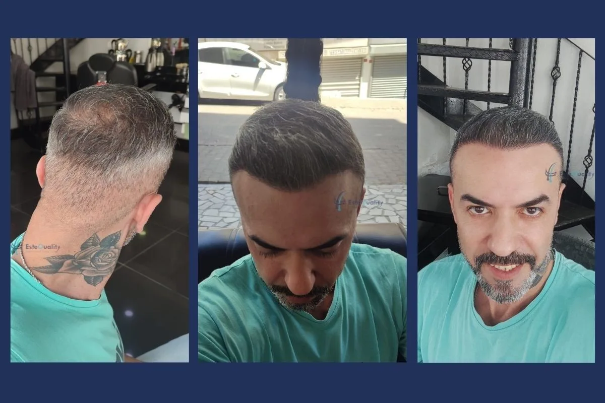 6.000 Grafts in einer Sitzung, davon 1.700 aus dem Bart, Sapphire FUE — ein anderer Patient als der zuvor gezeigte Spenderfall 