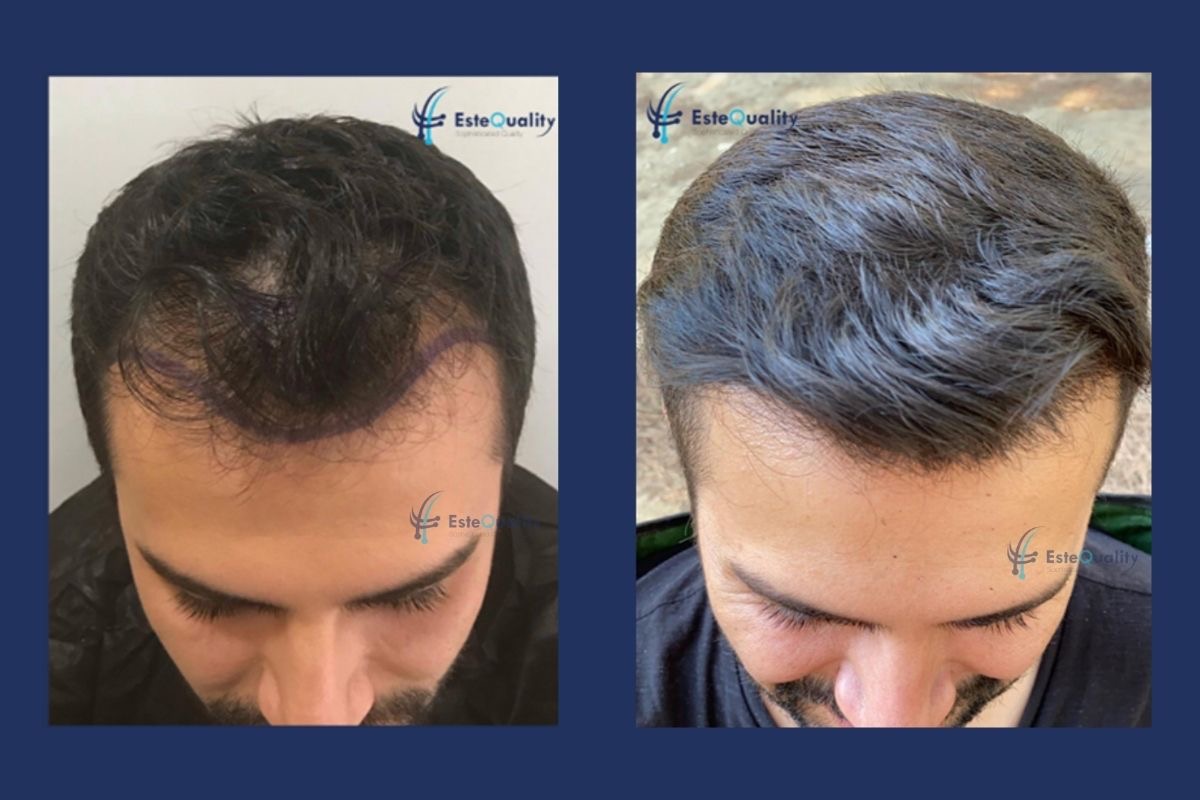 Before and 11 months after a 4,000-graft DHI hair transplant, front view of the hairline