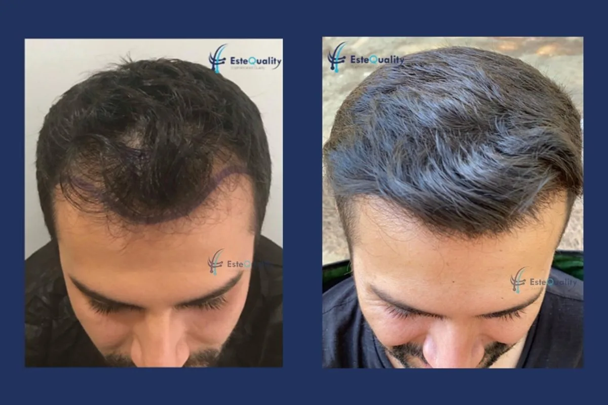 Patient in seinen 20ern. 4.000 Grafts, DHI, vorderer Haaransatz. Ergebnis nach 11 Monaten.