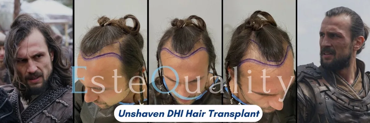 Haaransatz vor und 12 Monate nach unrasierter DHI, 2.750 Transplantate. Fotos am Set vor und nach dem Eingriff, mit der Planungsphase des Haaransatzes in der Klinik