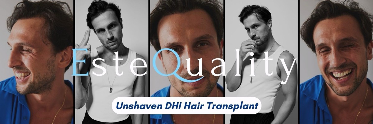 Burak, actor, unshaven DHI patient: 2,750 grafts, result at 12 months. Professional portraits provided by the
