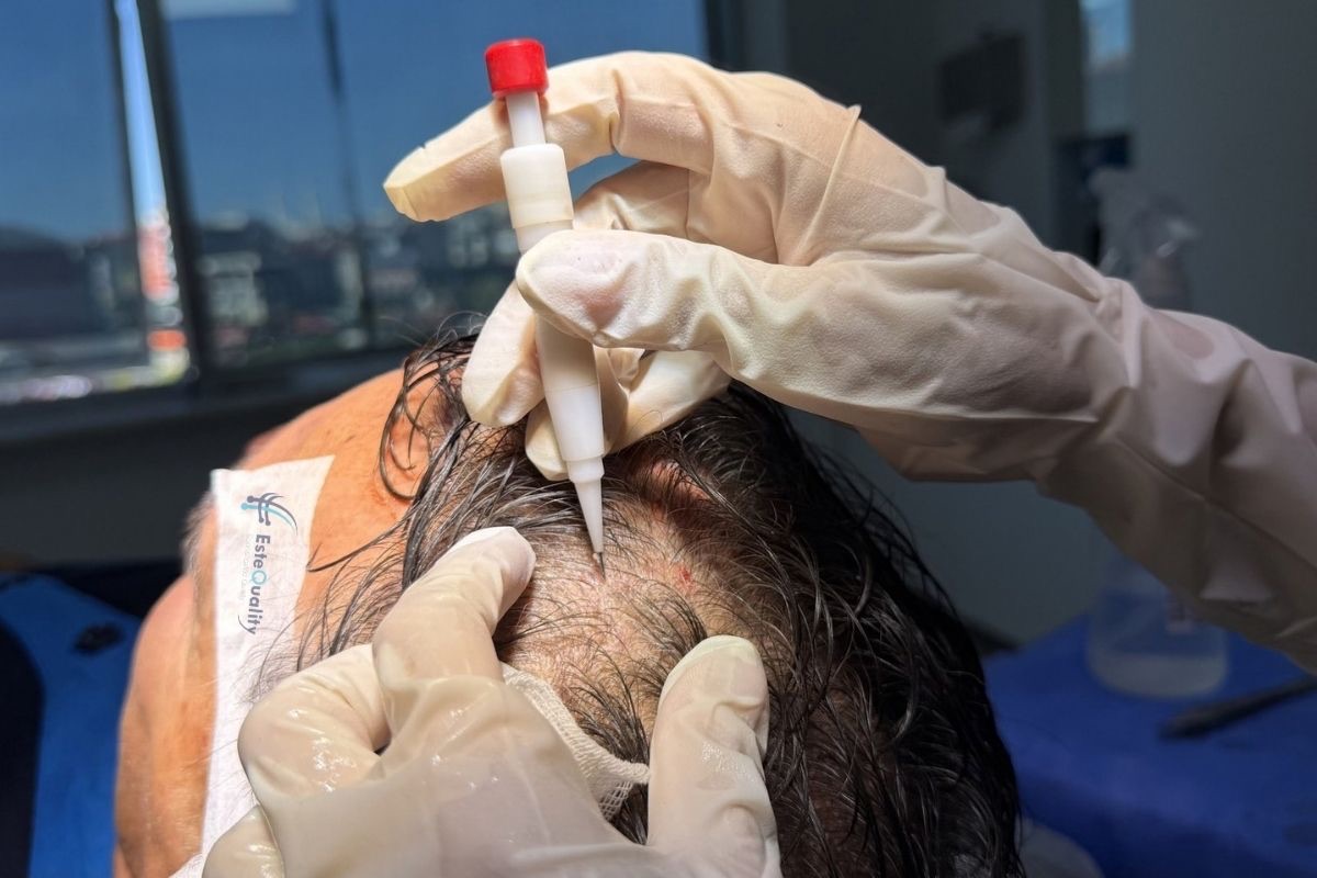 Unshaven DHI: grafts are placed between the existing hairs with the implanter pen; the recipient area is not s