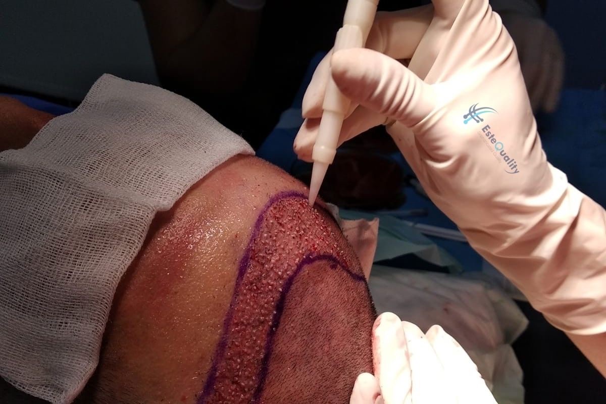 DHI implanter pen placing a graft into the scalp, close-up